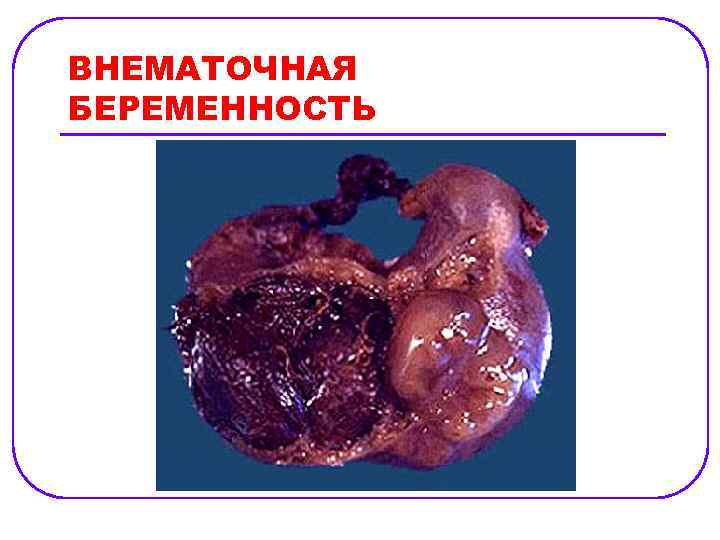 ВНЕМАТОЧНАЯ БЕРЕМЕННОСТЬ 