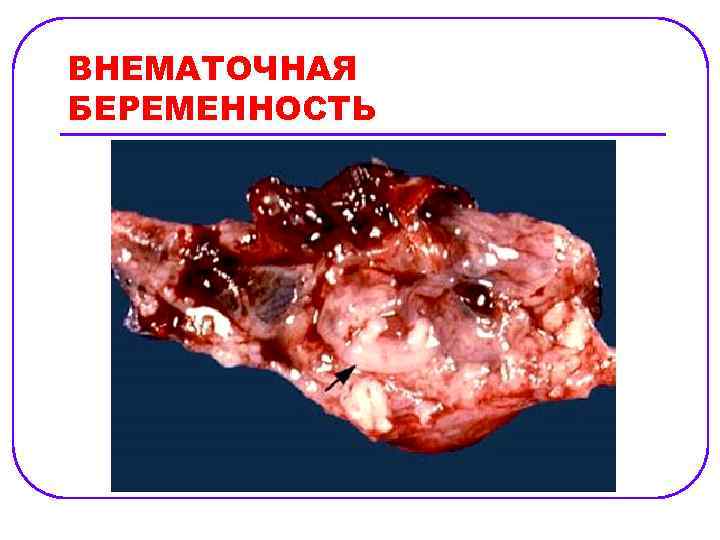 ВНЕМАТОЧНАЯ БЕРЕМЕННОСТЬ 