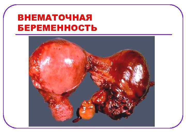 ВНЕМАТОЧНАЯ БЕРЕМЕННОСТЬ 