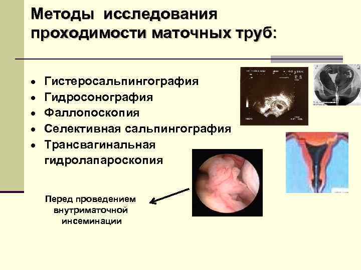 Методы исследования проходимости маточных труб: · · · Гистеросальпингография Гидросонография Фаллопоскопия Селективная сальпингография Трансвагинальная
