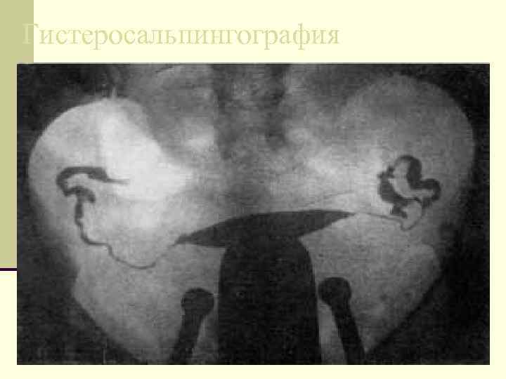Гистеросальпингография 