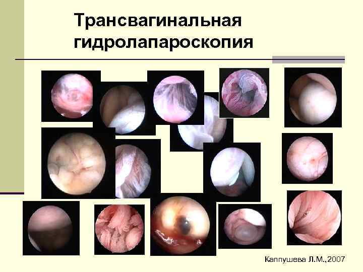 Трансвагинальная гидролапароскопия Каппушева Л. М. , 2007 