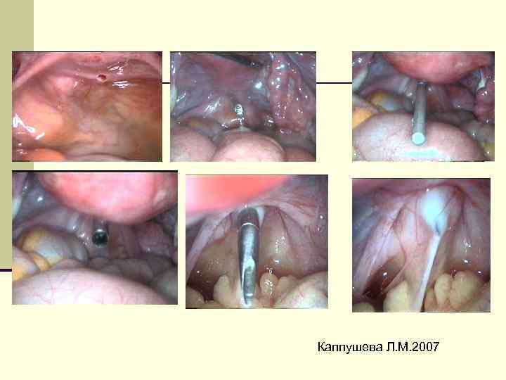 Трансвагинальная гидролапароскопия Каппушева Л. М. 2007 