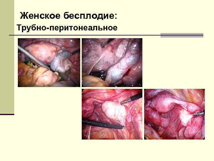 Женское бесплодие: Трубно-перитонеальное 