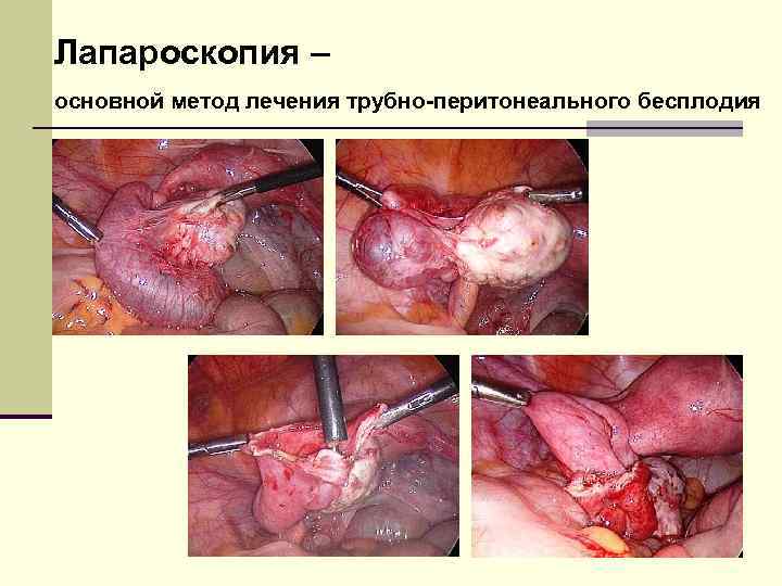 Лапароскопия – основной метод лечения трубно-перитонеального бесплодия 