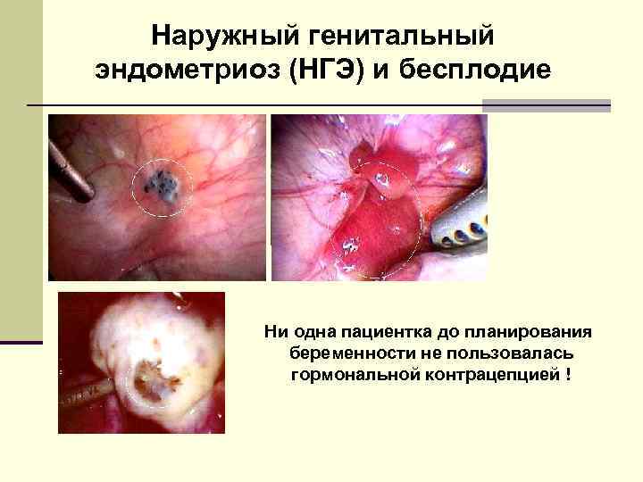 Наружный генитальный эндометриоз (НГЭ) и бесплодие Ни одна пациентка до планирования беременности не пользовалась