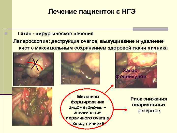 Лечение пациенток с НГЭ n I этап - хирургическое лечение Лапароскопия: деструкция очагов, вылущивание