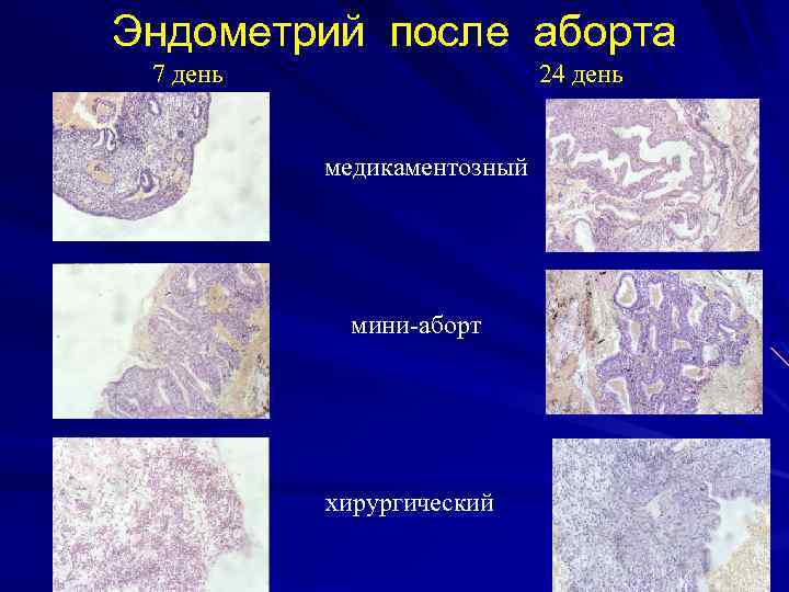 Эндометрий после аборта 7 день 24 день медикаментозный мини-аборт хирургический 