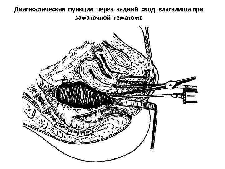 Диагностическая пункция через задний свод влагалища при заматочной гематоме 