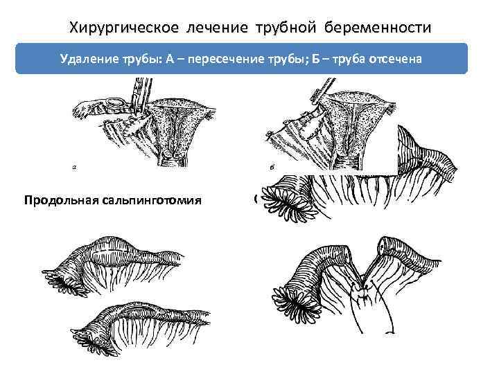 Хирургическое лечение трубной беременности Удаление трубы: А – пересечение трубы; Б – труба отсечена