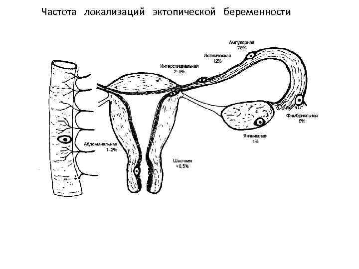 Частота локализаций эктопической беременности 