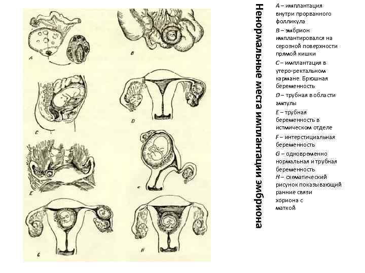 Ненормальные места имплантации эмбриона А – имплантация внутри прорванного фолликула В – эмбрион имплантировался