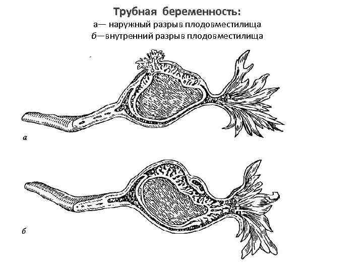 Трубная беременность: а— наружный разрыв плодовместилища б—внутренний разрыв плодовместилища 