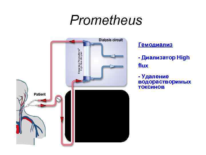 Prometheus Гемодиализ - Диализатор High flux - Удаление водорастворимых токсинов 