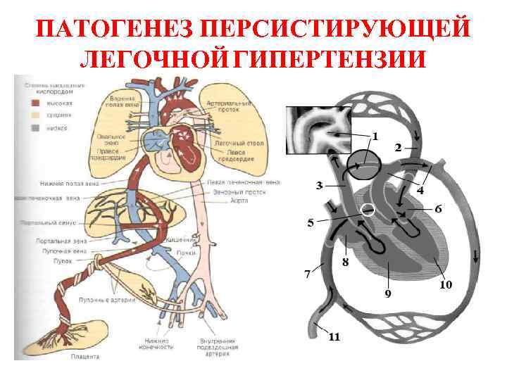 ПАТОГЕНЕЗ ПЕРСИСТИРУЮЩЕЙ ЛЕГОЧНОЙ ГИПЕРТЕНЗИИ 