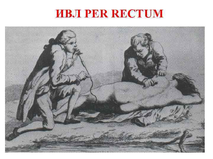 ИВЛ PER RECTUM 
