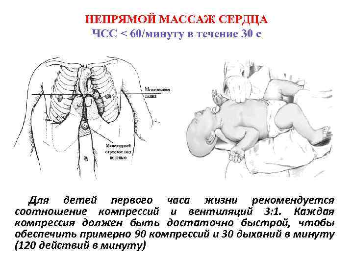 Слр новорожденных презентация