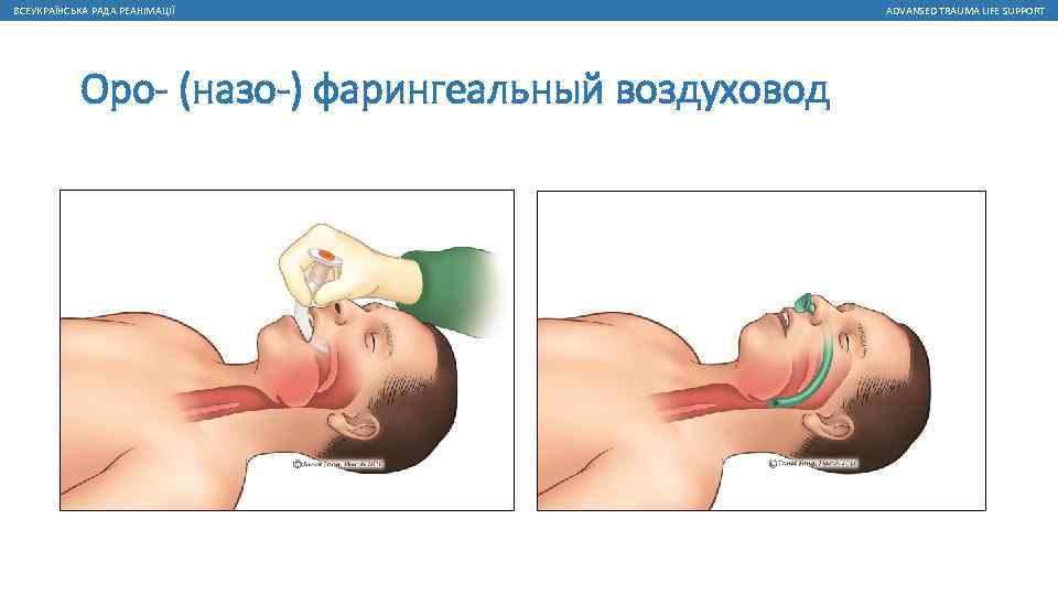 ВСЕУКРАЇНСЬКА РАДА РЕАНІМАЦІЇ Оро- (назо-) фарингеальный воздуховод ADVANSED TRAUMA LIFE SUPPORT 