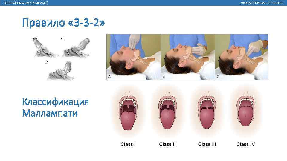 ВСЕУКРАЇНСЬКА РАДА РЕАНІМАЦІЇ Правило « 3 -3 -2» Классификация Маллампати ADVANSED TRAUMA LIFE SUPPORT