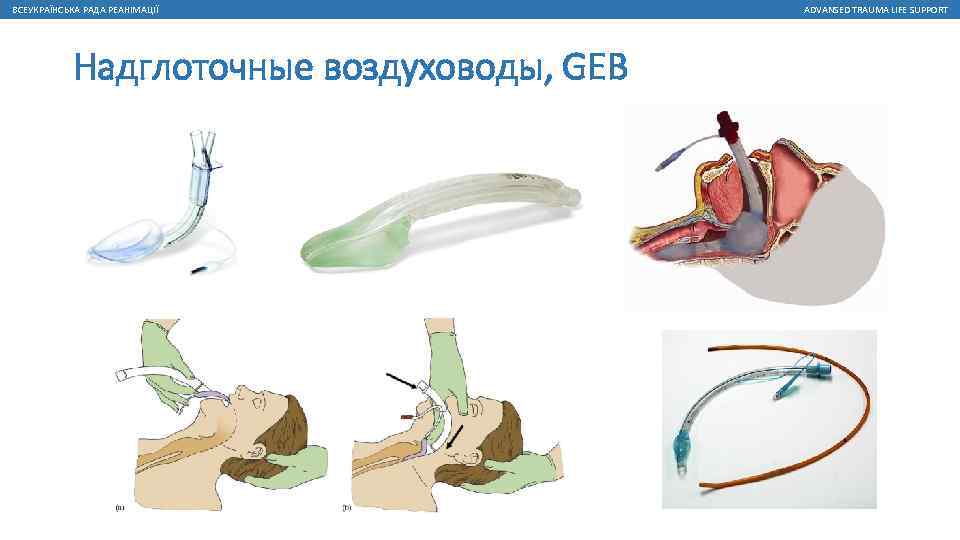 ВСЕУКРАЇНСЬКА РАДА РЕАНІМАЦІЇ Надглоточные воздуховоды, GEB ADVANSED TRAUMA LIFE SUPPORT 