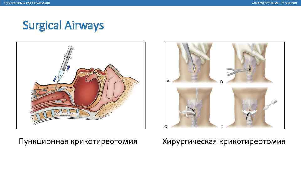 ВСЕУКРАЇНСЬКА РАДА РЕАНІМАЦІЇ ADVANSED TRAUMA LIFE SUPPORT Surgical Airways Пункционная крикотиреотомия Хирургическая крикотиреотомия 