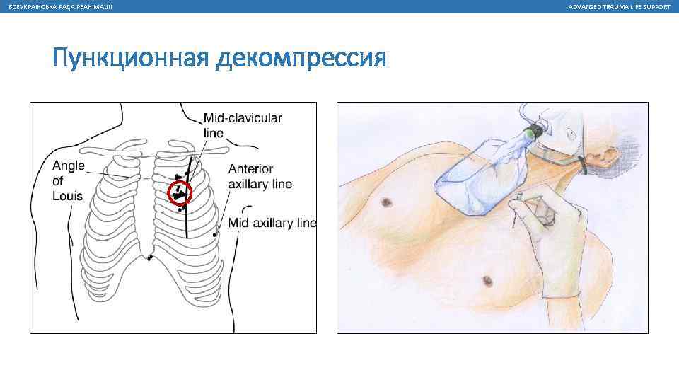 ВСЕУКРАЇНСЬКА РАДА РЕАНІМАЦІЇ Пункционная декомпрессия ADVANSED TRAUMA LIFE SUPPORT 