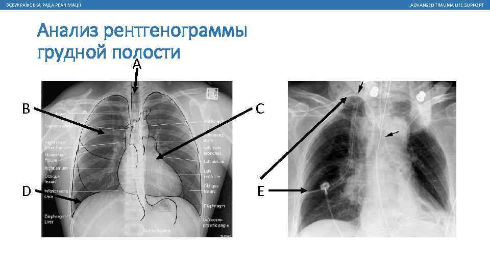 ВСЕУКРАЇНСЬКА РАДА РЕАНІМАЦІЇ ADVANSED TRAUMA LIFE SUPPORT Анализ рентгенограммы грудной полости A B C