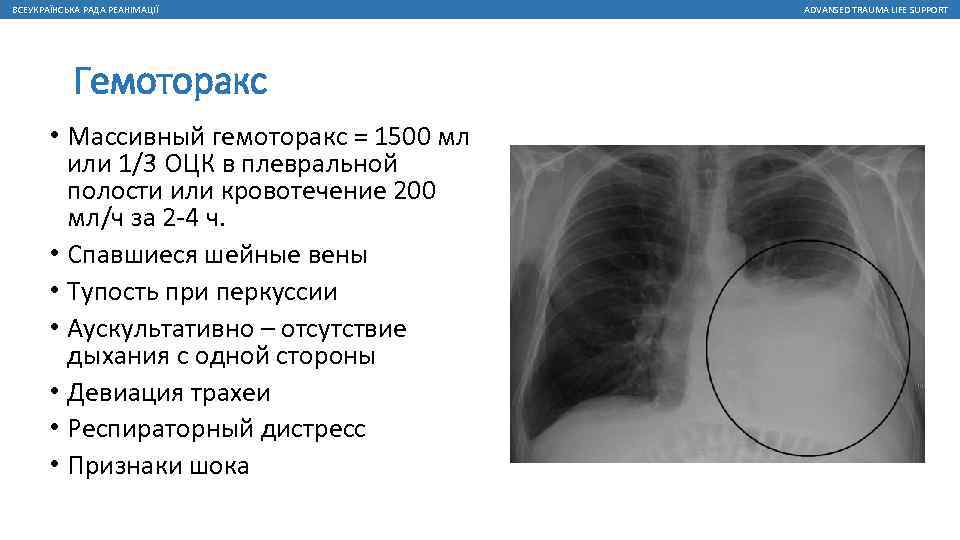 ВСЕУКРАЇНСЬКА РАДА РЕАНІМАЦІЇ Гемоторакс • Массивный гемоторакс = 1500 мл или 1/3 ОЦК в