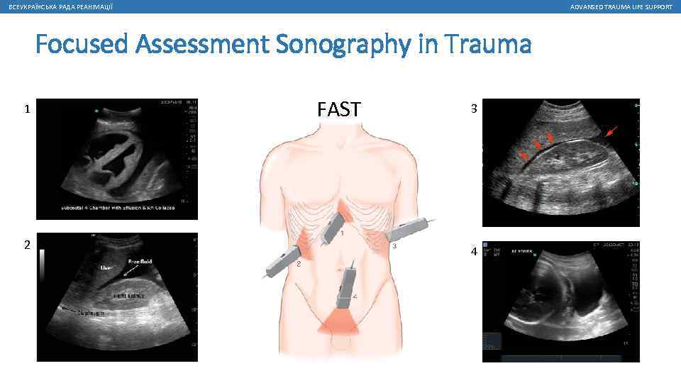 ВСЕУКРАЇНСЬКА РАДА РЕАНІМАЦІЇ ADVANSED TRAUMA LIFE SUPPORT Focused Assessment Sonography in Trauma 1 2