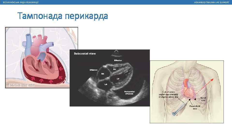 ВСЕУКРАЇНСЬКА РАДА РЕАНІМАЦІЇ Тампонада перикарда ADVANSED TRAUMA LIFE SUPPORT 