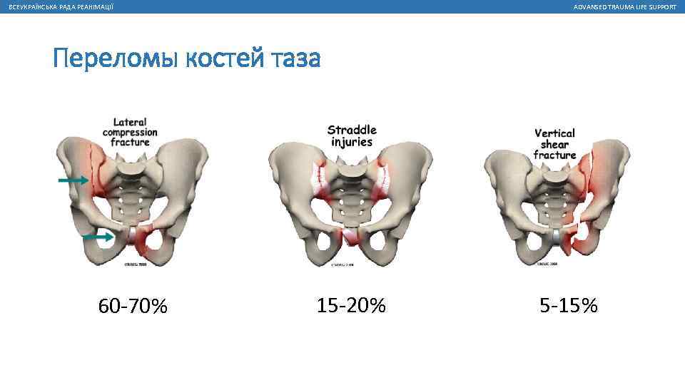 ВСЕУКРАЇНСЬКА РАДА РЕАНІМАЦІЇ ADVANSED TRAUMA LIFE SUPPORT Переломы костей таза 60 -70% 15 -20%