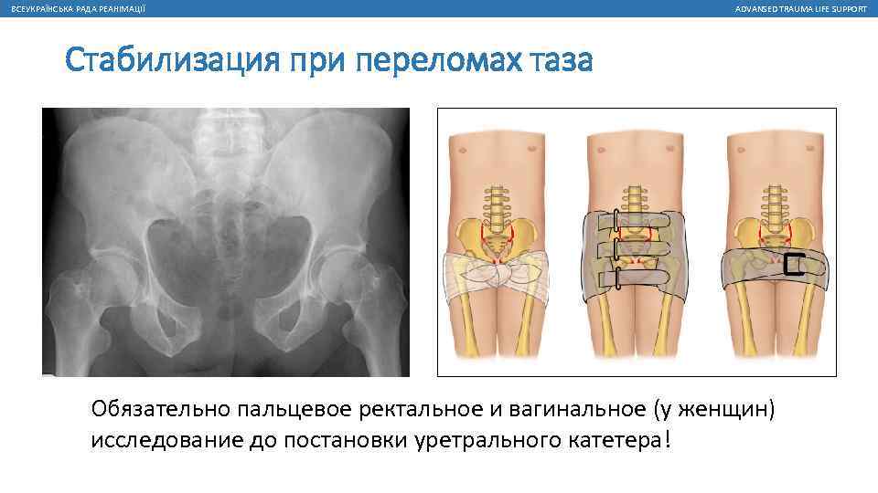 ВСЕУКРАЇНСЬКА РАДА РЕАНІМАЦІЇ ADVANSED TRAUMA LIFE SUPPORT Стабилизация при переломах таза Обязательно пальцевое ректальное