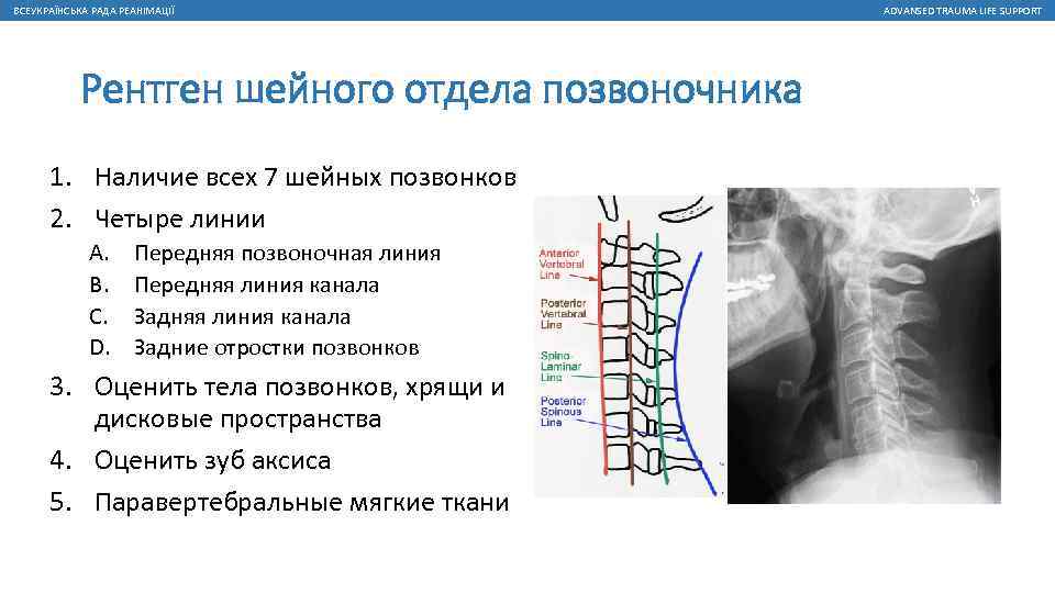 ВСЕУКРАЇНСЬКА РАДА РЕАНІМАЦІЇ Рентген шейного отдела позвоночника 1. Наличие всех 7 шейных позвонков 2.