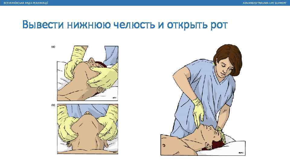 ВСЕУКРАЇНСЬКА РАДА РЕАНІМАЦІЇ Вывести нижнюю челюсть и открыть рот ADVANSED TRAUMA LIFE SUPPORT 