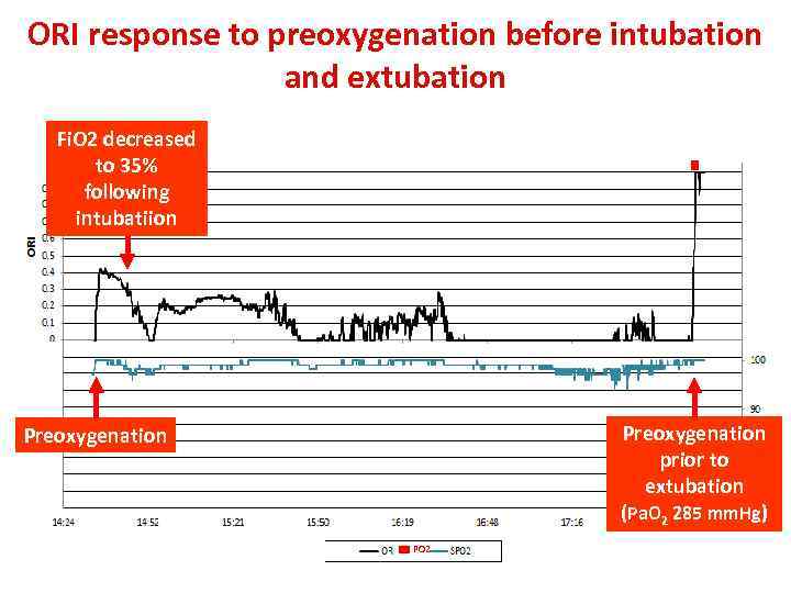 ORI response to preoxygenation before intubation and extubation Fi. O 2 decreased to 35%