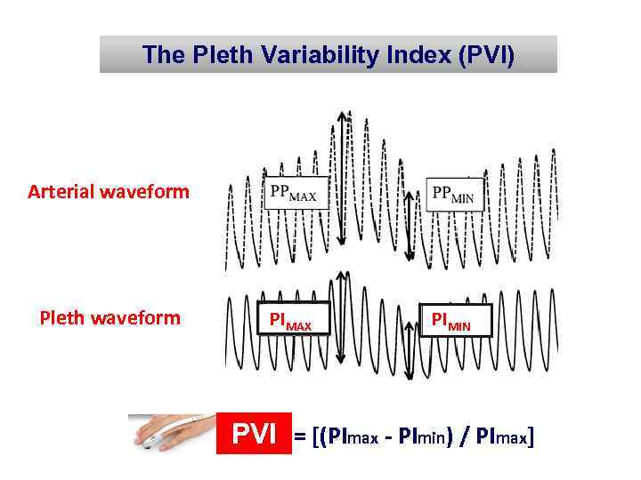 The Pleth Variability Index (PVI) Arterial waveform Pleth waveform PIMAX PIMIN PVI = [(PImax