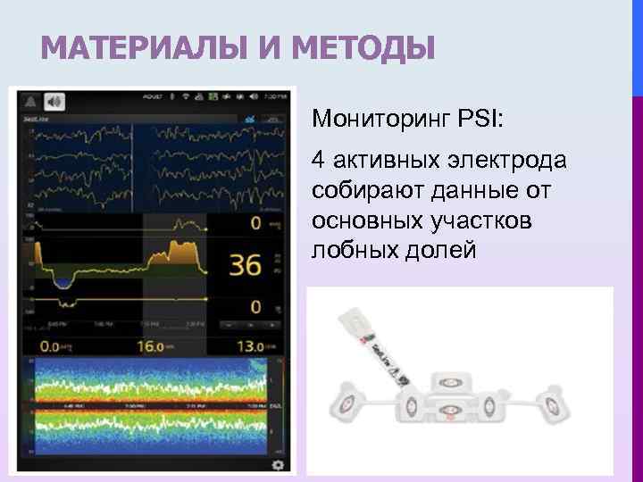 МАТЕРИАЛЫ И МЕТОДЫ Мониторинг PSI: 4 активных электрода собирают данные от основных участков лобных