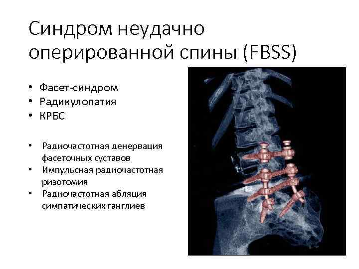 Синдромы поясничного отдела позвоночника. Фасеточный синдром поясничного отдела рентген. Фасет синдром грудного отдела. Фасеточный синдром грудного отдела позвоночника. Фасеточный синдром шейного отдела позвоночника.