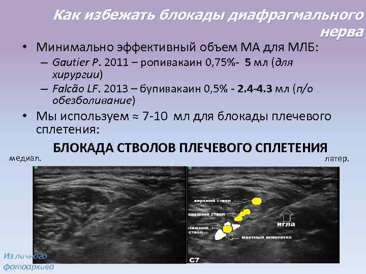 Как избежать блокады диафрагмального нерва • Минимально эффективный объем МА для МЛБ: – Gautier