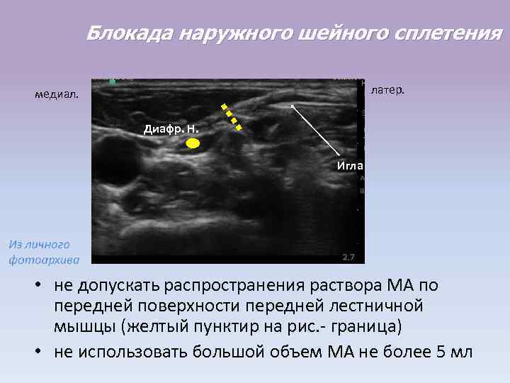 Блокада наружного шейного сплетения латер. медиал. Диафр. Н. Игла • не допускать распространения раствора