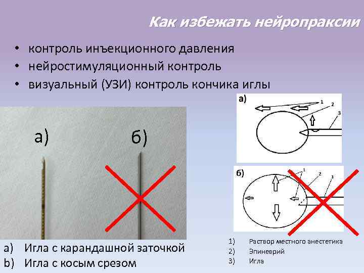 Как избежать нейропраксии • контроль инъекционного давления • нейростимуляционный контроль • визуальный (УЗИ) контроль