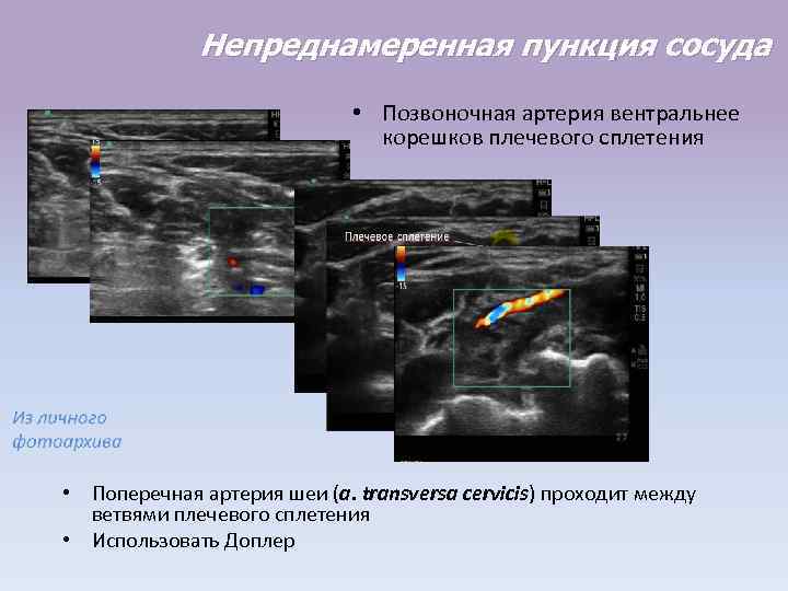 Непреднамеренная пункция сосуда • Позвоночная артерия вентральнее корешков плечевого сплетения • Поперечная артерия шеи