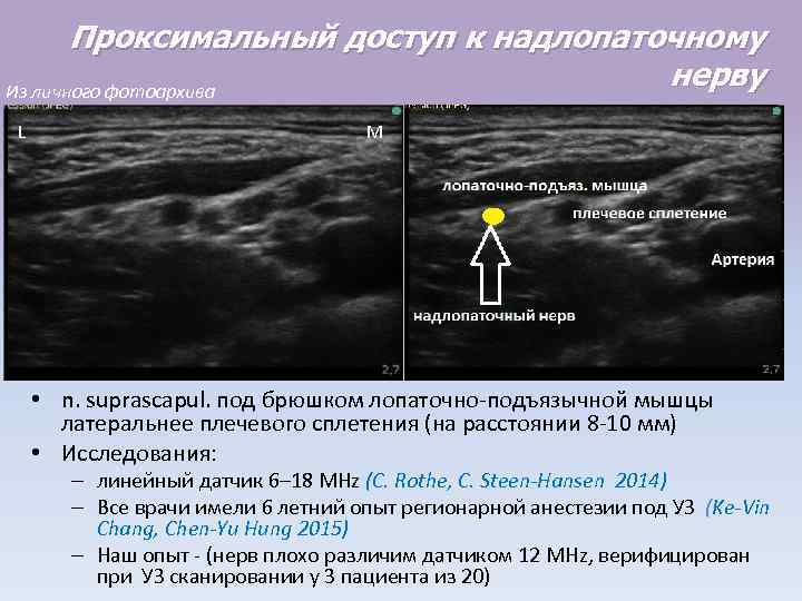 Проксимальный доступ к надлопаточному нерву Из личного фотоархива L M • n. suprascapul. под