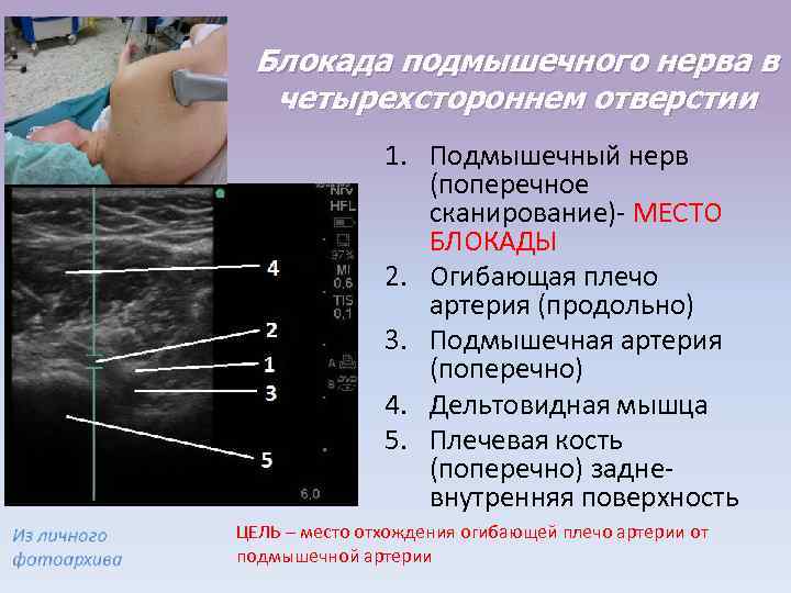 Блокада подмышечного нерва в четырехстороннем отверстии 1. Подмышечный нерв (поперечное сканирование)- МЕСТО БЛОКАДЫ 2.