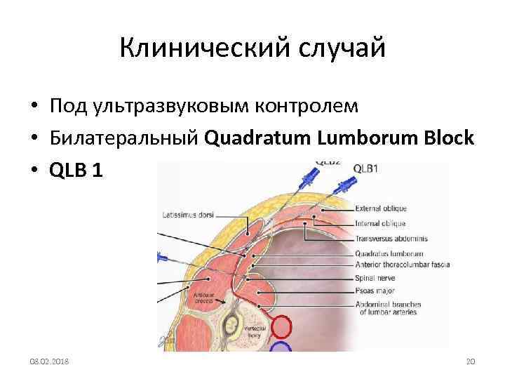 Клинический случай • Под ультразвуковым контролем • Билатеральный Quadratum Lumborum Block • QLB 1