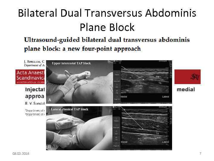 Bilateral Dual Transversus Abdominis Plane Block 08. 02. 2018 7 