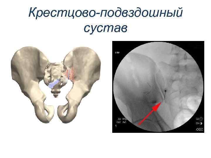 Крестцово подвздошное сочленение где находится фото на человеке