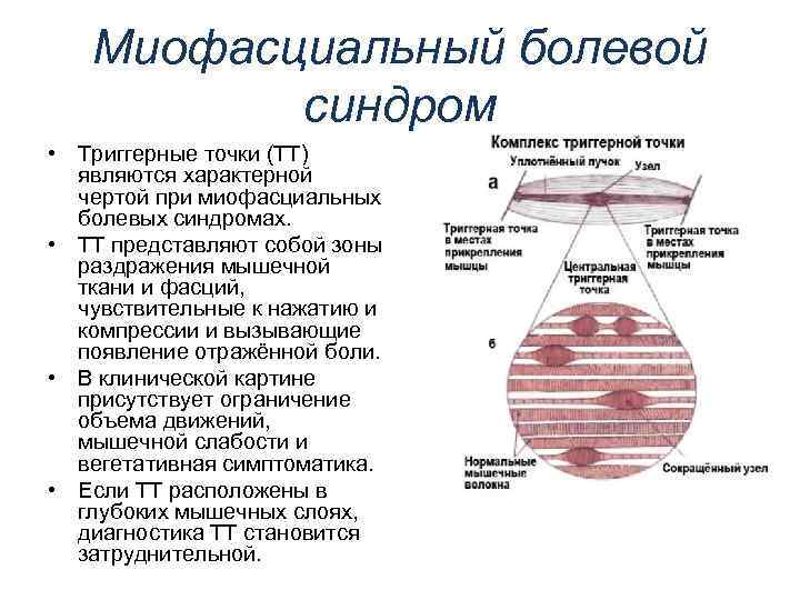 Миофасциальный болевой синдром. Мышечно-фасциальный болевой синдром. Миофасциальный синдром. Миофасциальный триггерный синдром. Миофасциальная дисфункция.