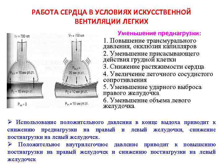 РАБОТА СЕРДЦА В УСЛОВИЯХ ИСКУССТВЕННОЙ ВЕНТИЛЯЦИИ ЛЕГКИХ Уменьшение преднагрузки: 1. Повышение трансмурального давления, окклюзия