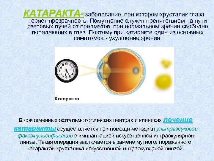 КАТАРАКТА- заболевание, при котором хрусталик глаза теряет прозрачность. Помутнение служит препятствием на пути световых